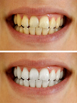 whitening-before-and-after